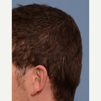 35-44 year old man treated with Skull Augmentation Surgery after 1702428