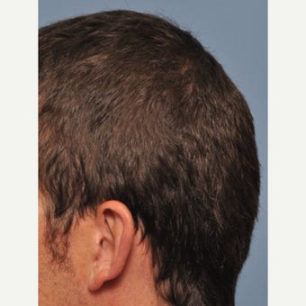 35-44 year old man treated with Skull Augmentation Surgery before 1702428