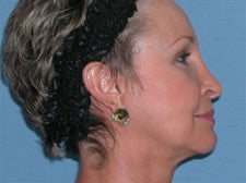 45-54 year old woman treated with Facelift 3529926
