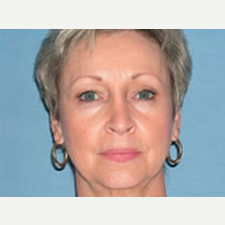 45-54 year old woman treated with Facelift before 3529926