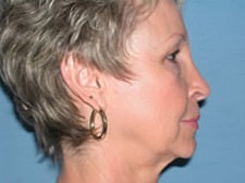 45-54 year old woman treated with Facelift 3529926
