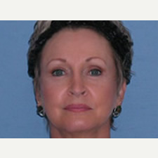 45-54 year old woman treated with Facelift after 3529926