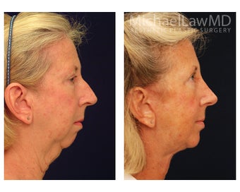 Facial Rejuvenation before 1285283