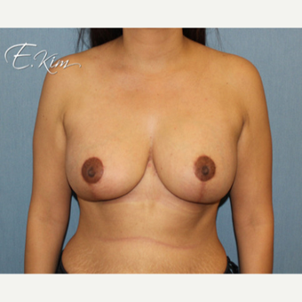 25-34 year old woman treated with Breast Lift with Implants after 3663355