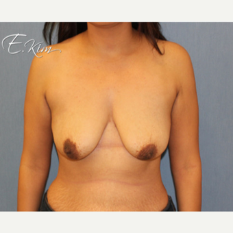 25-34 year old woman treated with Breast Lift with Implants before 3663355