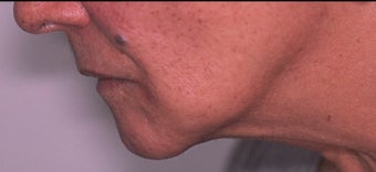 70 year old woman 3 months following treatment for sagging neck and jowls with Ultherapy after 1531908