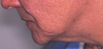 70 year old woman 3 months following treatment for sagging neck and jowls with Ultherapy before 1531908