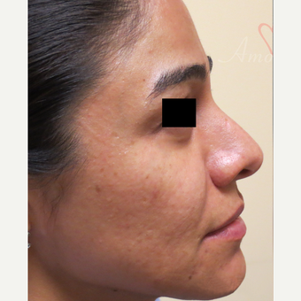 25-34 year old woman treated with Acne Scars Treatment before 3375030