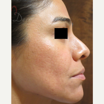 25-34 year old woman treated with Acne Scars Treatment after 3375030