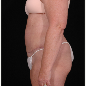 55-64 year old woman treated with Tummy Tuck after 3052654