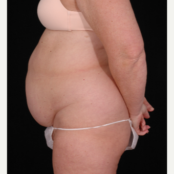 55-64 year old woman treated with Tummy Tuck before 3052654