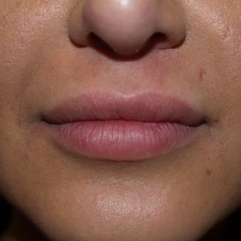 25-34 year old woman treated with Lip Augmentation after 3571283