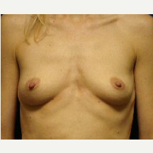 35-44 year old woman treated with Breast Implants before 3669883