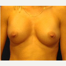 35-44 year old woman treated with Breast Implants after 3669883
