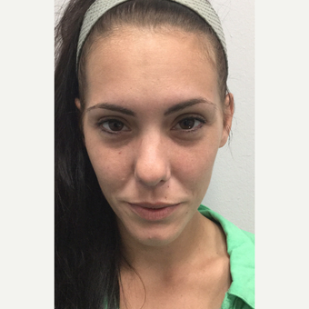 25-34 year old woman treated with Juvederm before 3762032