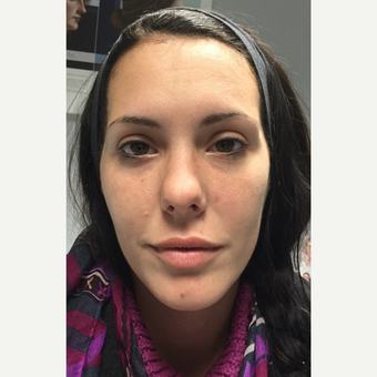 25-34 year old woman treated with Juvederm after 3762032