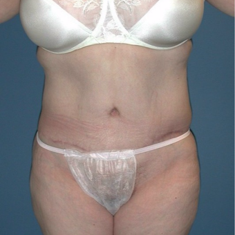 45-54 year old woman treated with Tummy Tuck after 3682409