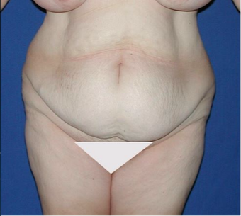 45-54 year old woman treated with Tummy Tuck before 3682409