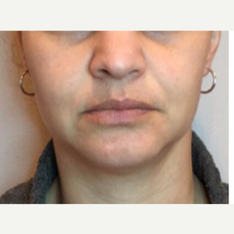 35-44 year old woman treated with Injectable Fillers before 2975993