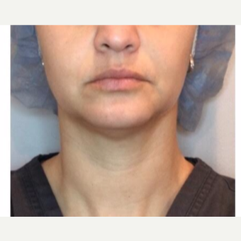 35-44 year old woman treated with Injectable Fillers after 2975993