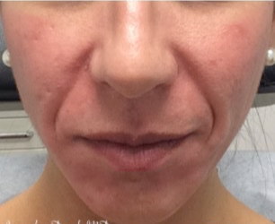 35-44 year old woman treated with Wrinkle Treatment before 3767384