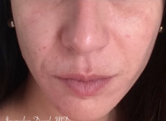 35-44 year old woman treated with Wrinkle Treatment after 3767384