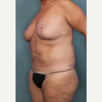 55-64 year old woman treated with Breast Reduction after 3442597