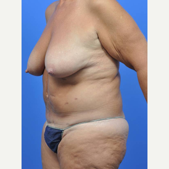 55-64 year old woman treated with Breast Reduction before 3442597
