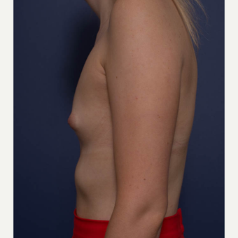 18-24 year old woman treated with Breast Augmentation before 3766937