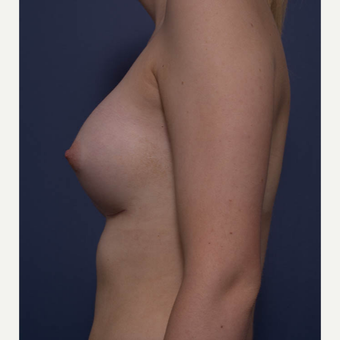 18-24 year old woman treated with Breast Augmentation after 3766937