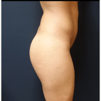 25-34 year old woman treated with 548cc Round Silicone Butt Implants for her Butt Augmentation before 3033300