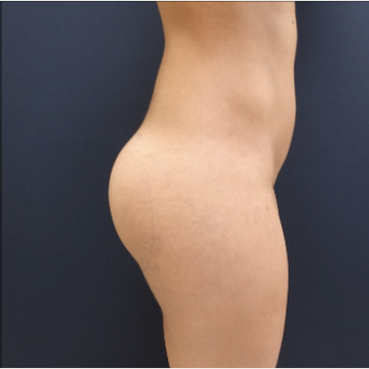 25-34 year old woman treated with 548cc Round Silicone Butt Implants for her Butt Augmentation after 3033300
