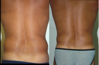 39-year-old man treated with Liposuction. after 574556