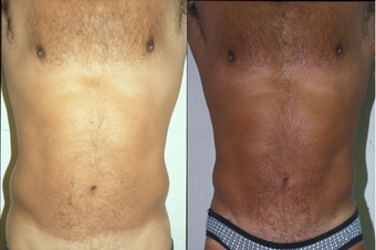 39-year-old man treated with Liposuction. before 574556