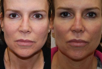 Permanent Lip Augmentation with Silikon-1000 before 1327189