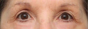 Laser Resurfacing after 965165