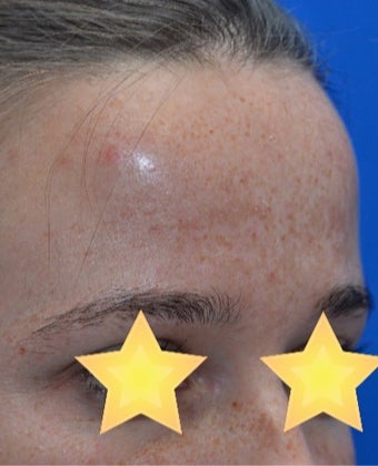 Skin Rejuvenation before 3141055