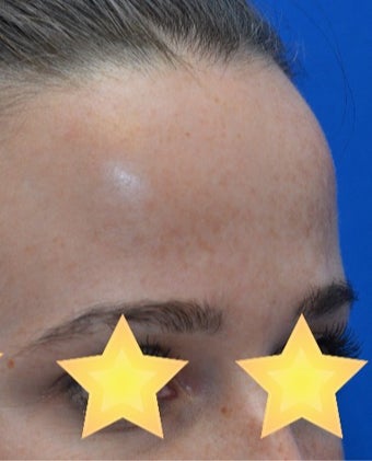 Skin Rejuvenation after 3141055