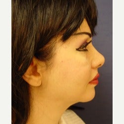 35-44 year old woman treated with Thread Lift after 2079279