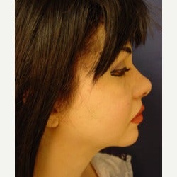 35-44 year old woman treated with Thread Lift before 2079279