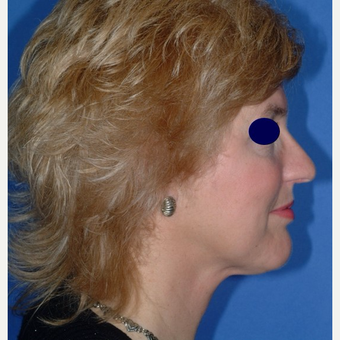 Rhinoplasty after 3325476