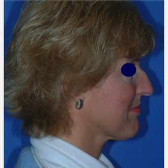 Rhinoplasty before 3325476