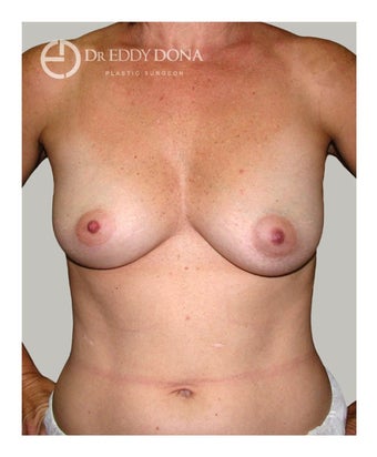 45-54 year old woman treated with Breast Augmentation before 1672265