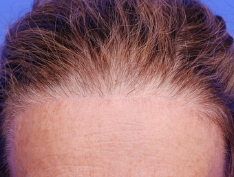 Forehead scar revision after 1341270