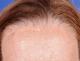 Forehead scar revision before 1341270