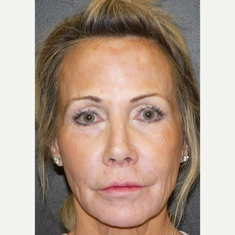 55-64 year old woman treated with Microneedling using the Venus Viva RF Microneedling system before 3002079