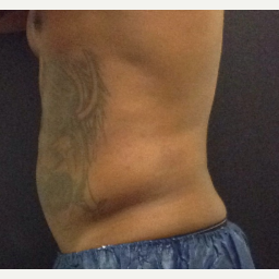 35-44 year old man treated with SculpSure after 3624917