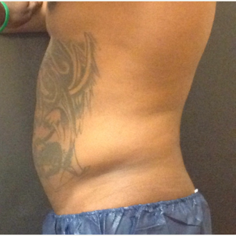 35-44 year old man treated with SculpSure before 3624917