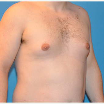 25-34 year old man treated with Male Breast Reduction before 3705397
