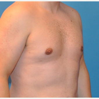 25-34 year old man treated with Male Breast Reduction after 3705397